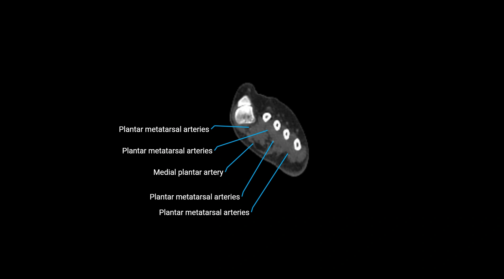 CTA lower limb cross sectional anatomy labelled image _301.webp